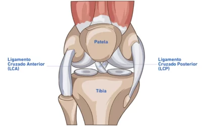 Lesión del Ligamento Cruzado: LCA y LCP