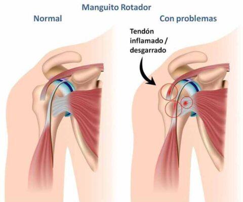 Tendinopatía del manguito rotador: causas, síntomas y tratamiento