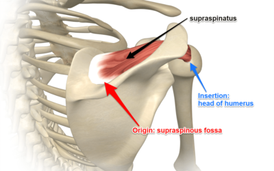 Tendinitis del supraespinoso: causas, síntomas, diagnóstico y tratamiento