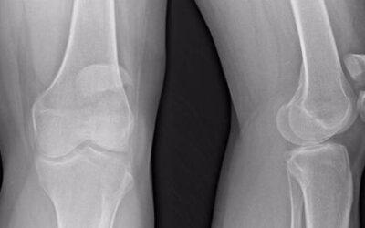 Fracturas de rótula: causas, diagnóstico y tratamiento