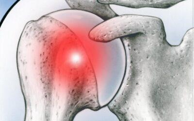 Hombro congelado o Capsulitis adhesiva