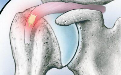 Tendinitis calcificante de hombro: causas, síntomas y tratamiento