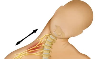 El Complejo Nervioso del Plexo Braquial: Funciones, Anatomía y Lesiones