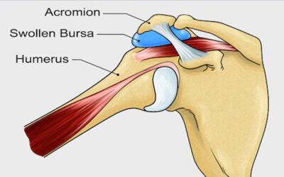 Bursitis Subacromial: Causas, Síntomas, Tratamiento y Prevención