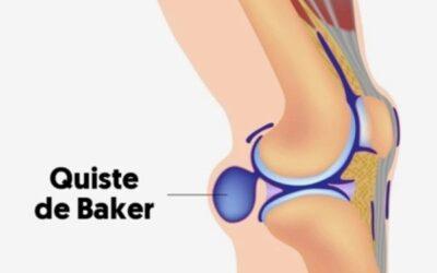 Quiste de Baker: síntomas, diagnóstico y tratamiento